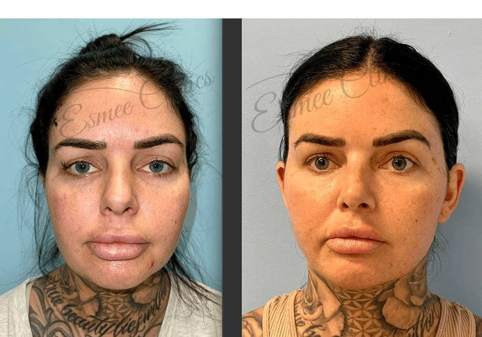 Before and After img